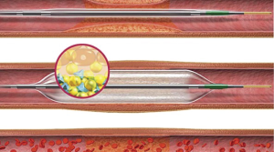 Apakah angioplasti tanpa stent (atau Angioplasti Tanpa Stent/PCI Tanpa Stent)?