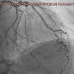 Apakah angioplasti tanpa stent (atau Angioplasti Tanpa Stent/PCI Tanpa Stent)? WhatsApp Image 2026 05 18 At 8.54.51 AM 3 150x150