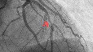 Silent Heart Disease Detected in Young Hiker: Life-Saving Angioplasty Performed