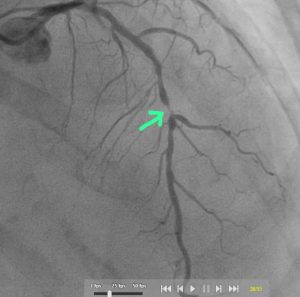 Life-Saving Coronary Intervention in a Kidney Failure Patient with Critical CAD
