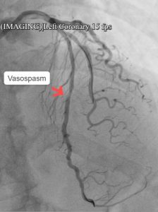 Protecting the Heart During Chemotherapy: Successful Management of Coronary Spasm